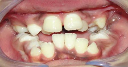 Maloclusion-Dental-en-Ni--os-450x237.